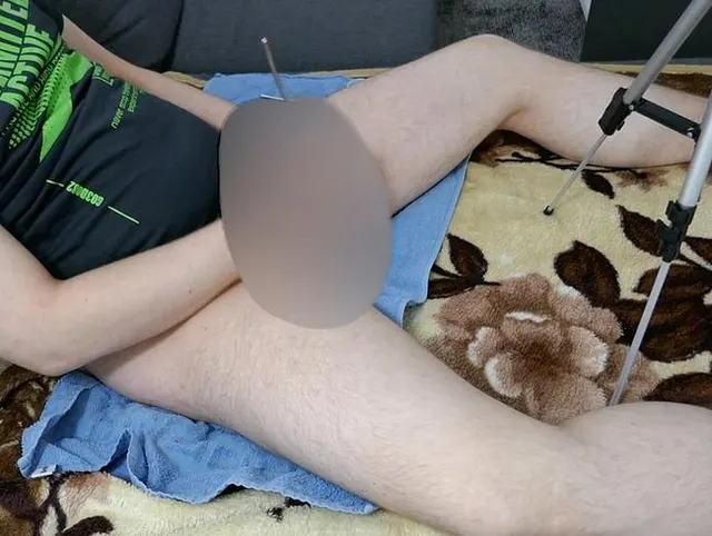 Video 140 - Hard Dilator Training - Cam 2 -Teil 1-3