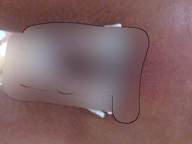 Lippenklemmen